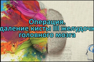 Операция. Удаление кисты III желудочка головного мозга