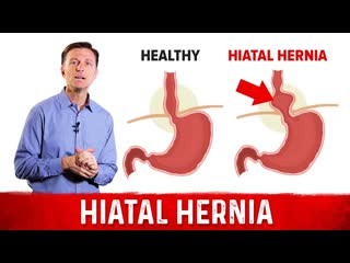 Quick Fix For Hiatal Hernia  Dr. Berg